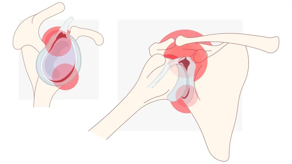Bankart Lezyonu Nedir?