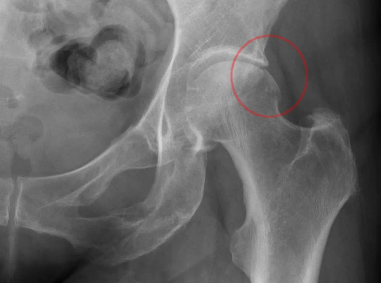 Kalça Ağrısı Femoroasetabular Sıkışma (FAS / FAI) Nedir?