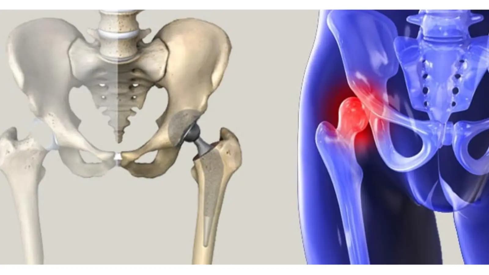 Kalça Anatomisi ve Minimal İnvaziv Kalça Protezi