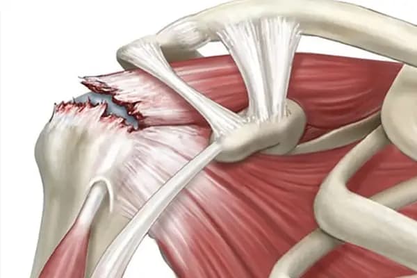 Rotator Kuf Sendromu Nedir?