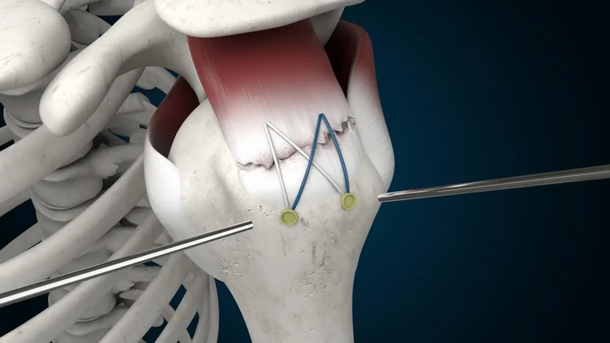 Rotator Manşet Yırtığı Tedavisi