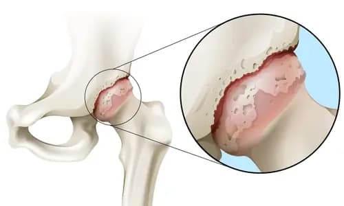 Kalça Kireçlenmesi Nedir?