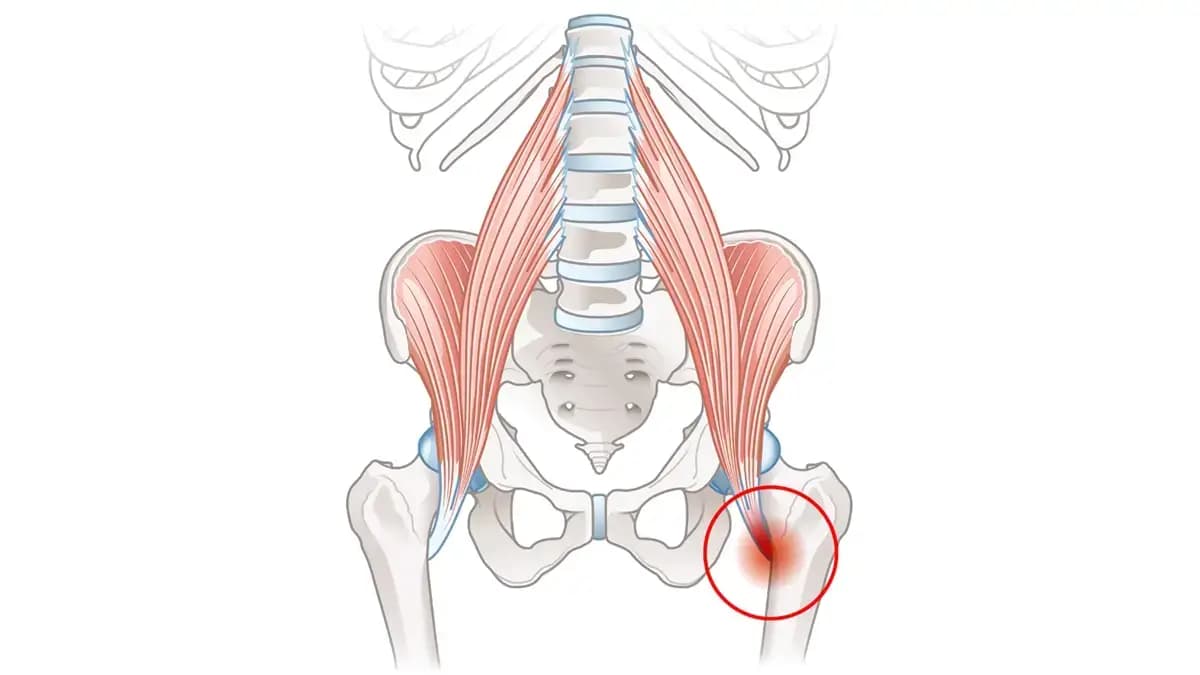 Kalça Tendiniti Nedir?