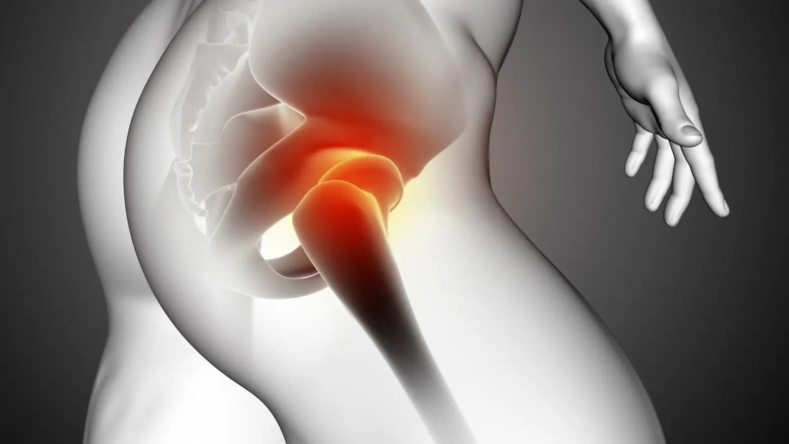 Kalça Ağrısı Nedir?