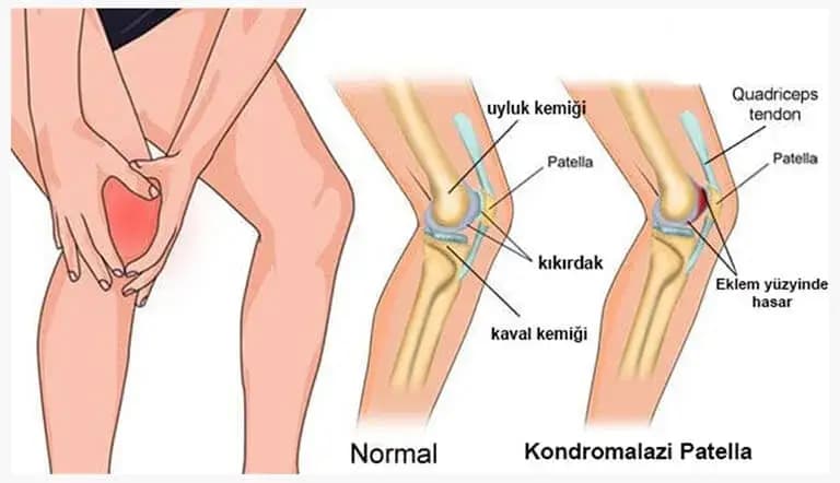 Kondromalazi Patella (Koşucu Dizi) Nedir?