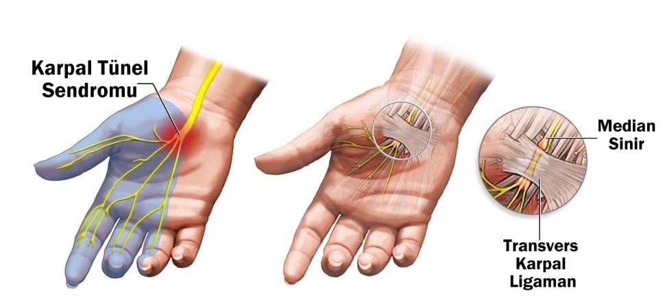 Karpal Tünel Sendromu Nedir?