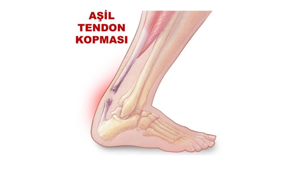 Aşil Tendonu Yırtığı Nasıl Tedavi Edilir?
