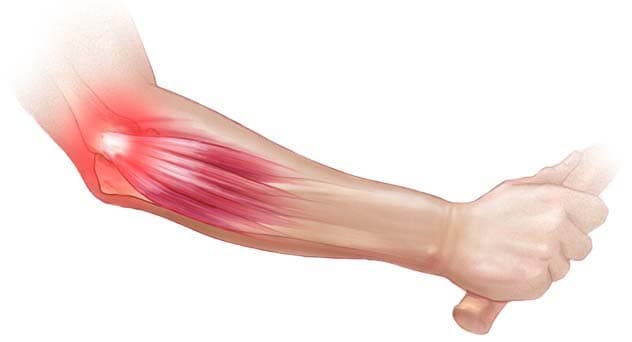 Tenisçi Dirseği (Lateral Epikondilit) Nedir?