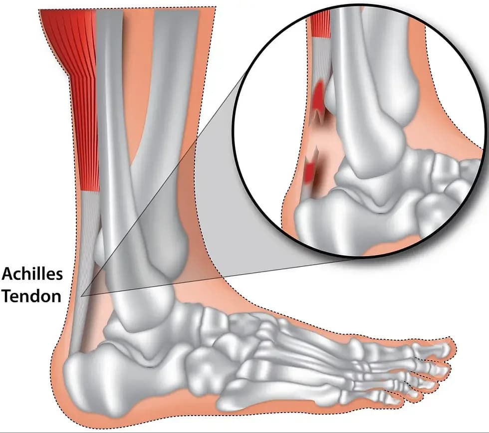 Aşil Tendonu Yırtığı Nasıl Tedavi Edilir?