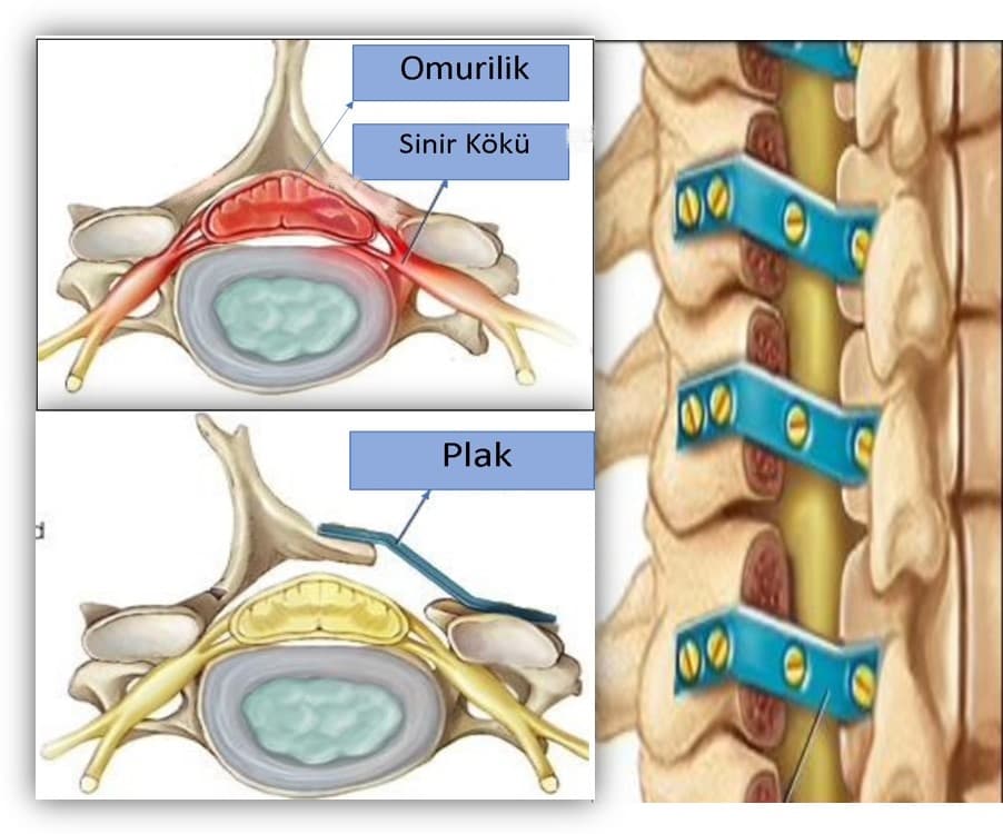 Servikal Diskopati Nedir?