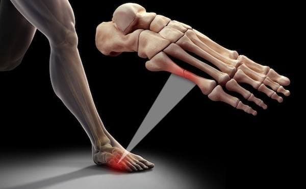 Stres Kırığı Tedavisi