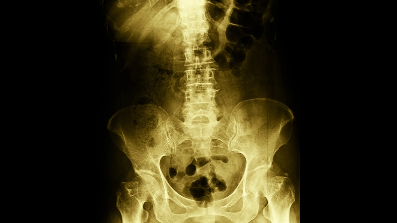 Kalça Kireçlenmesi Nedenleri