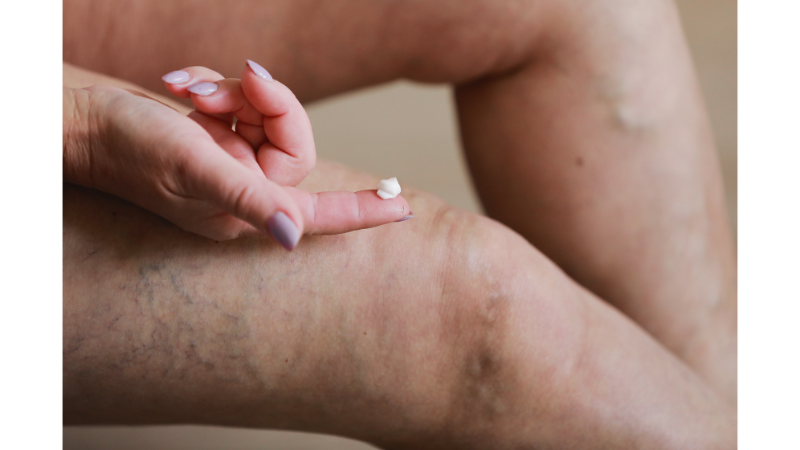 Using Cream for Knee Edema